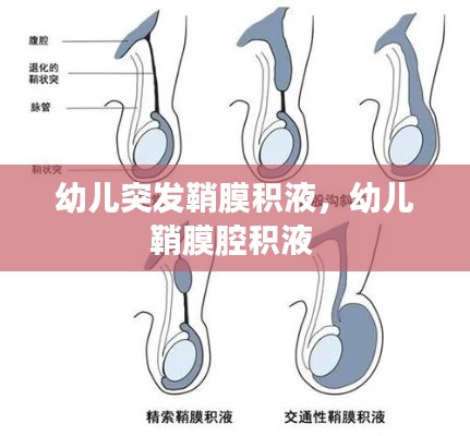 幼兒突發(fā)鞘膜積液，幼兒鞘膜腔積液 
