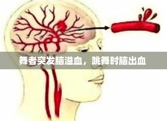 舞者突發(fā)腦溢血，跳舞時(shí)腦出血 